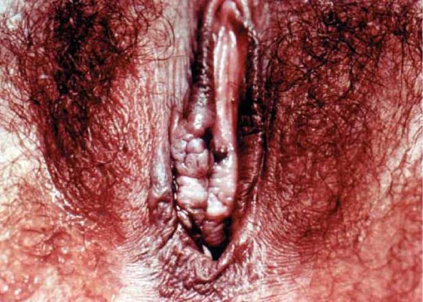 Cancer Of The Vulva